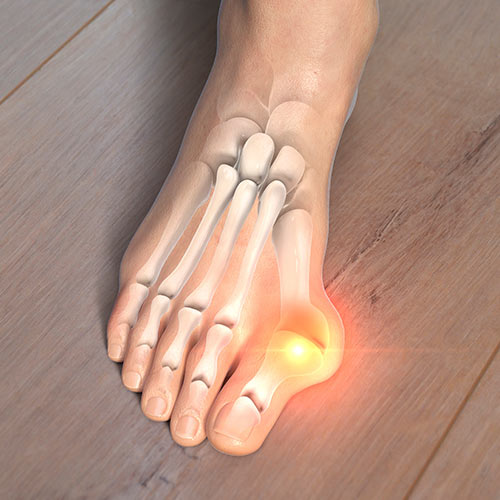 Bunionectomy