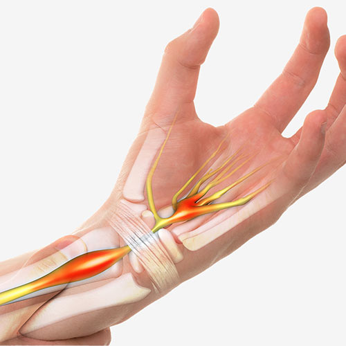 Carpal Tunnel Release