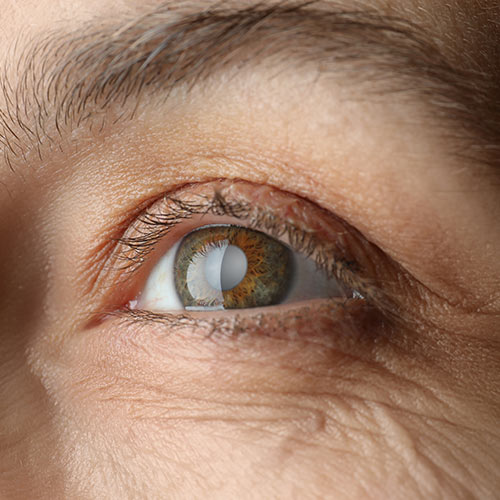 Cataract Surgery