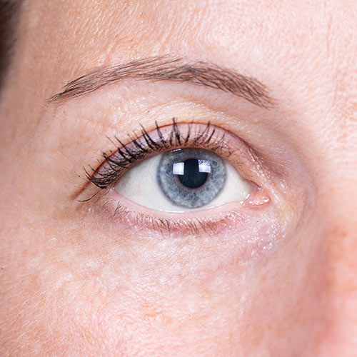 Blepharoplasty / Eyelid Lift