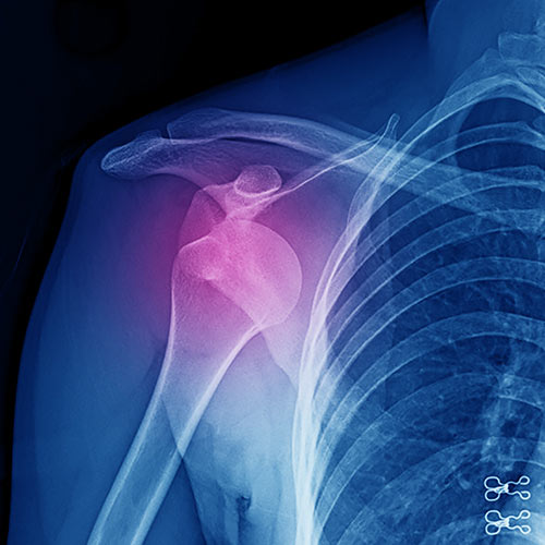 Rotator Cuff